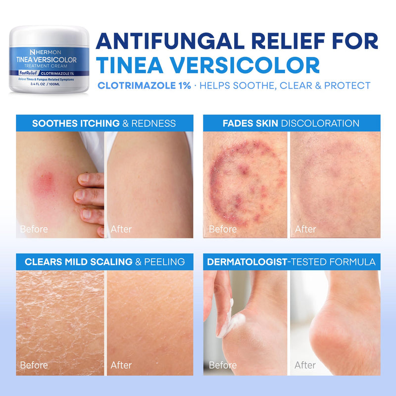 Hermon Tinea Versicolor Treatment Cream:Multi-Functional Clinically Proven 1% Clotrimazole Cream for Athlete's Foot, Tinea Versicolor, Jock Itch, Ringworm 3.4 Ounce (pack of 1) - BeesActive Australia
