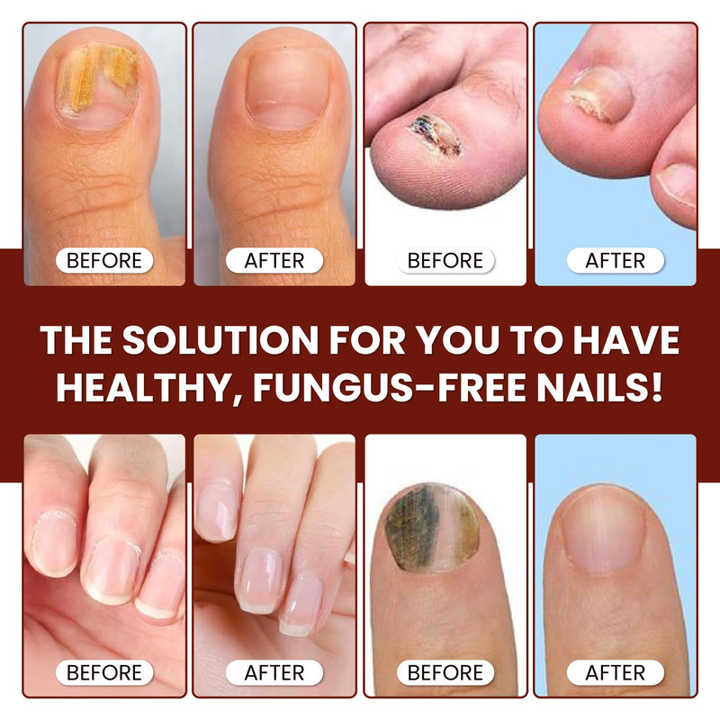 Abera Maximum Strength Nail Repair Serum - Intensive Care for Damaged and Hardened Nails - Supports Healthy Nails with Quick-Drying Formula for Fingernails and Toenails (Red) A. Red