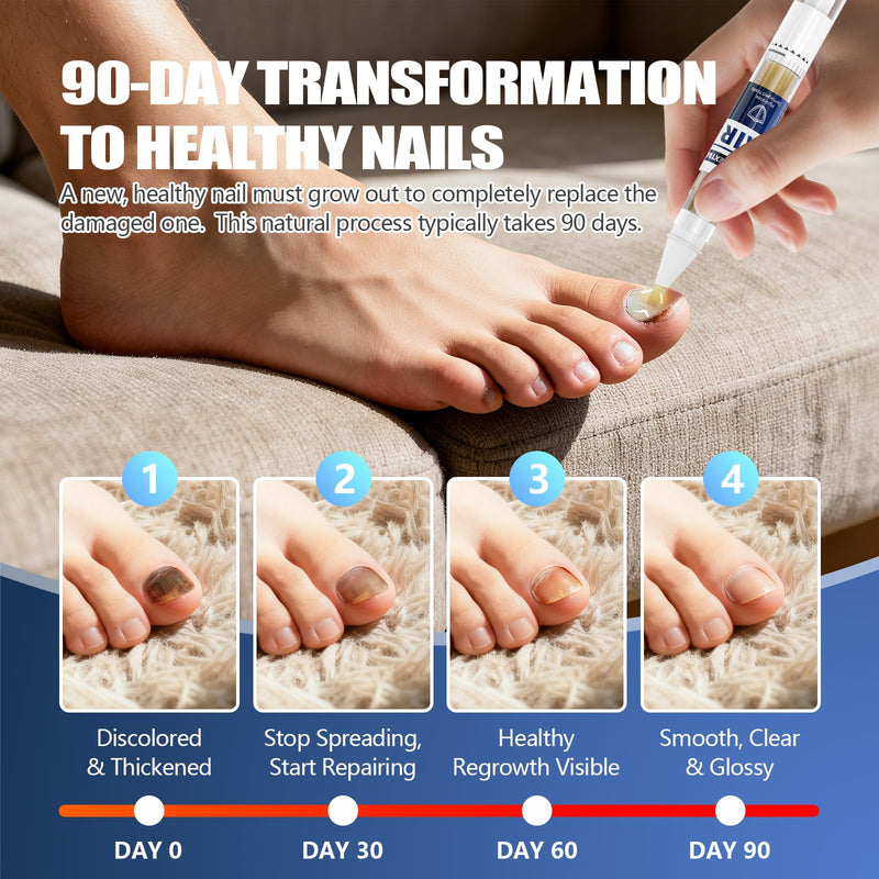 Toenail Fungus Pen – 25% Undecylenic Acid, Toenail Fungus Treatment Extra Strength, Nail Fungus Treatment Pen for Toenail & Finger, 5 x 3ml, Complete Care Kit with Nail Tools