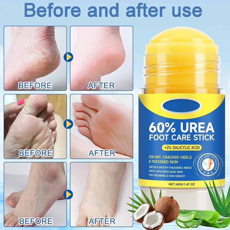 60% Urea with 2% Salicylic Acid Foot Care Stick, Maximum Strength Urea Foot Cream Callus Remover for Dry Cracked Heels, Hands, Knees, Exfoliating Moisturizer, Dead Skin Remover Foot Balm 1.41oz 1.41 Fl Oz (Pack of 1)