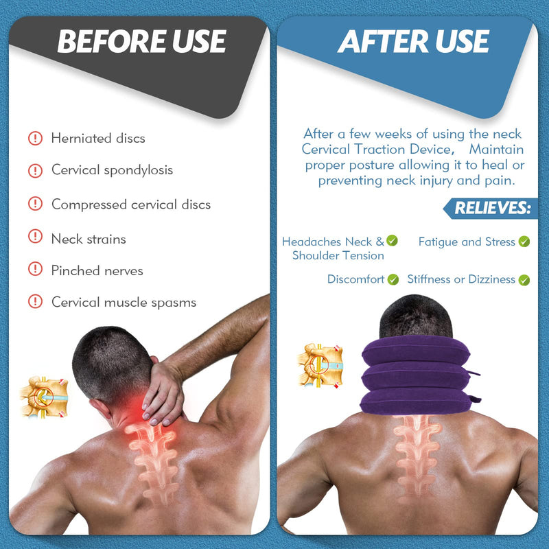 Neck Stretcher for Neck Pain Relief, Cervical Traction Device, Neck Traction Device, Adjustable Inflatable Neck Brace & Cervical Neck Traction Device Home Use Decompression(Purple) Purple - BeesActive Australia