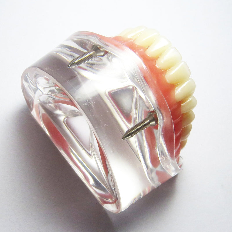 Dental Model Overdenture Inferior 2 Implants Demo for Studing and Teaching