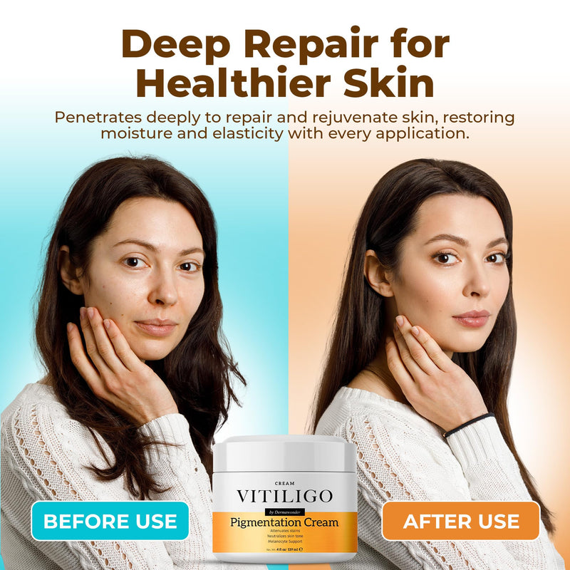 Dermawonder Vitiligo Supplement & Pigmentation Cream Set | 60 Vitiligo Capsules and 4fl Oz Cream | Reduce White Spots, Improve Skin Pigmentation & Neutralize Skin Tone | Natural Solution (1) 60 Count (Pack of 1), 4 Fl Oz (Pack of 1)