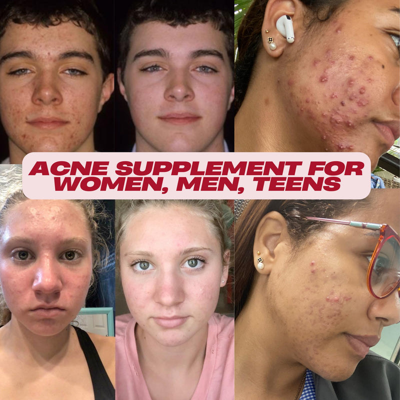 Acnetame 3 Pack- Vitamin Supplements for Acne Treatment- Hormonal Pimple Tablets to Clear Oily Skin for Women, Men, Teens, and Adults