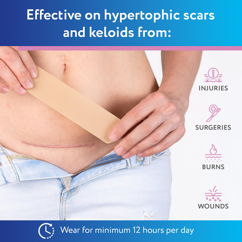 ScarAway Advanced Silicone Scar Sheets for C-Section, Reusable Strips (1.5” x 7”) for Hypertrophic and Keloid Scars from C-Section & Other Surgeries, 4 Sheets - BeesActive Australia