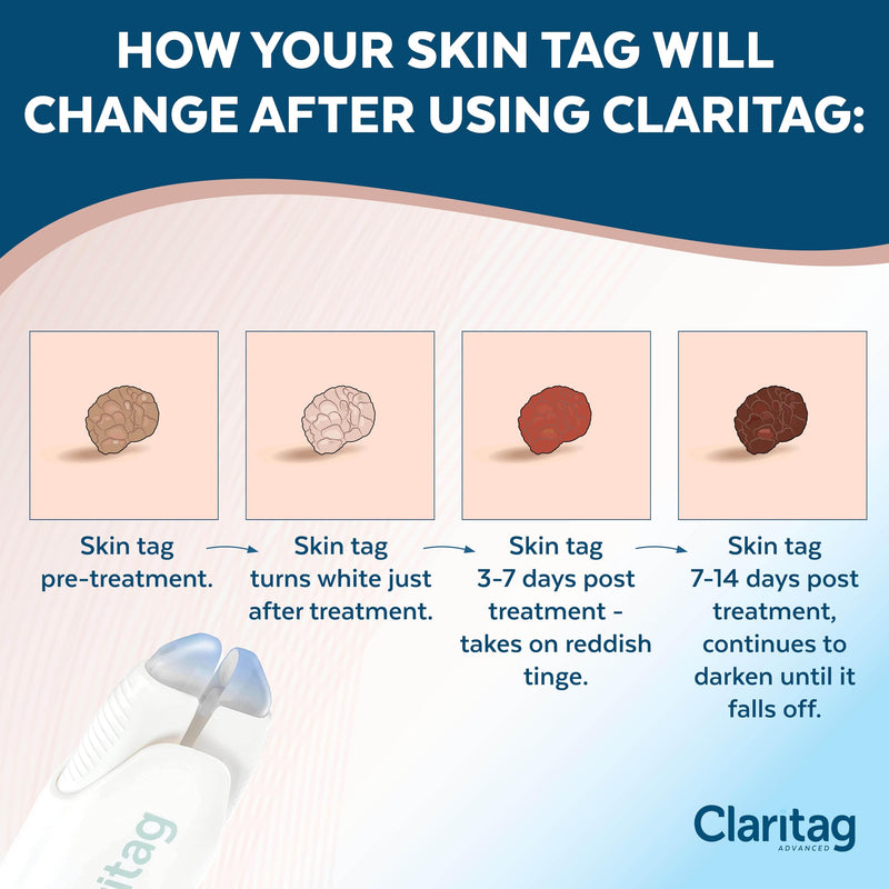 Advanced Skin Tag Remover - FDA-Cleared Device - Only for Skin Tag Removal - Works in 7-14 Days - Up to 10 Treatment Cycles - Cryogenic Freeze-Off Kit - BeesActive Australia