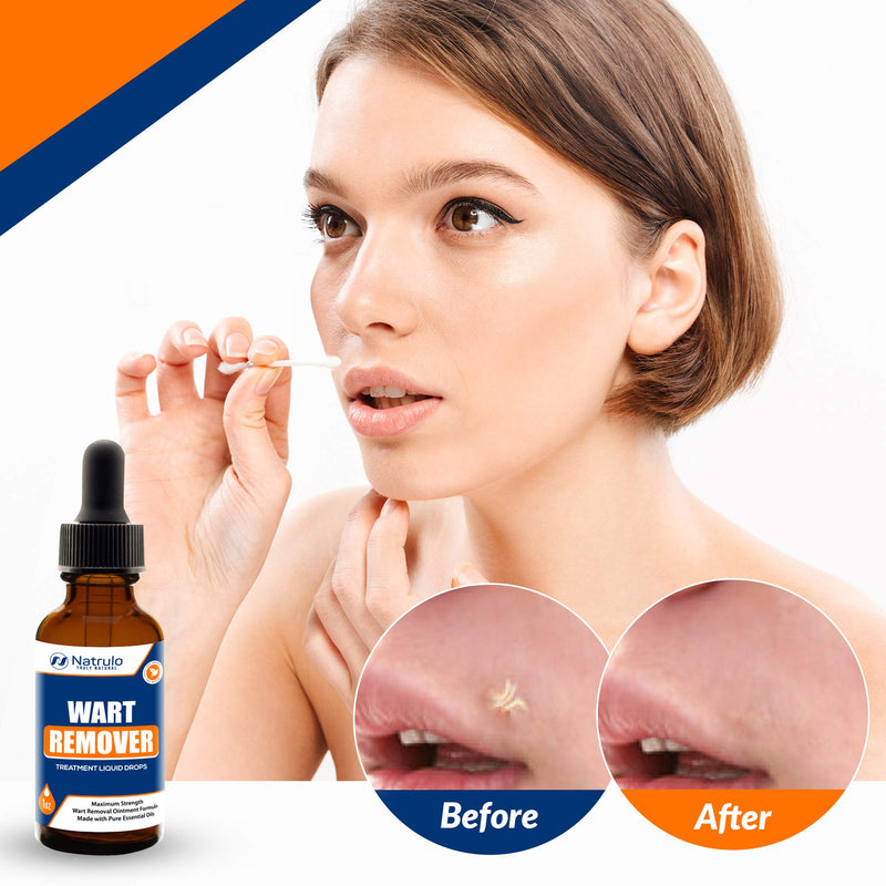 Natural Wart Oil Liquid Drops – Fast, Safe for Kids, Maximum Strength Wart Ointment with Pure Essential Oils – No Pain, No Scarring, Easy to Use on Face, Neck, Body, Hands, Feet - BeesActive Australia