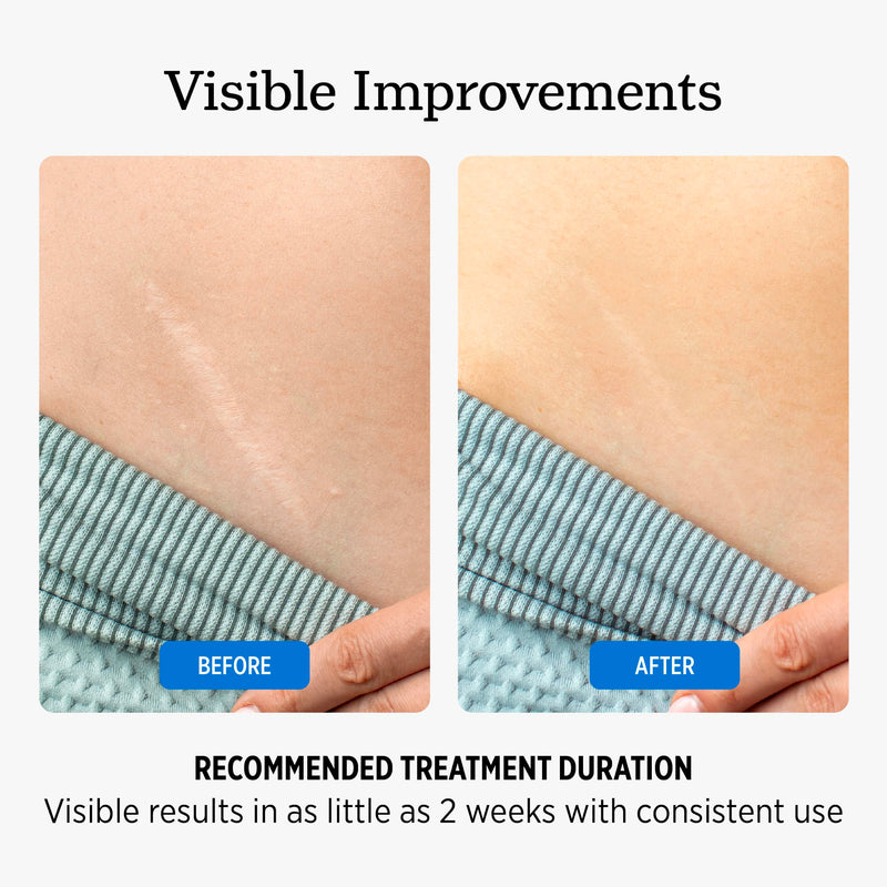 NUVADERMIS Overnight Intensive Scar Cream with Retinol, Allantoin, Vitamin E, Betaine – 1.35 Fl Oz PM Scar Cream Treatment for C-Sections, Keloids & Post-Surgery Care 1.35 Fl Oz (Pack of 1)