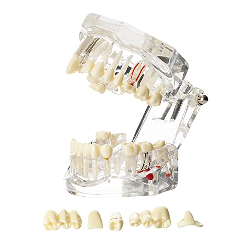 Dental Oral Typodont Model Implant Pathological Removable Teach Demo Visible Anatomy Demonstration Teaching Standard Size (Clear)