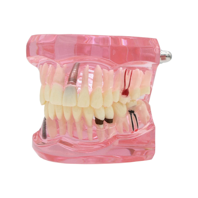 Teeth Model Teeth Typodonts Dental Implant Study Analysis Demonstration Teeth Model #2001 with Restoration Pink - BeesActive Australia
