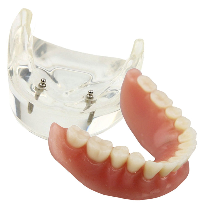 Dental Model Overdenture Inferior 2 Implants Demo for Studing and Teaching