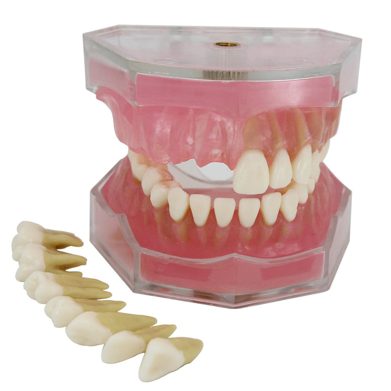 Dental Implant Teeth Model with Removable Teeth for Dental Professionals and Students - BeesActive Australia