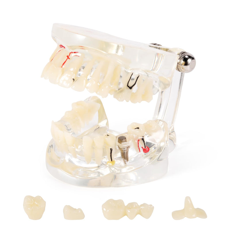 Annhua Transparent Disease Teeth Model for Dental Students, 32 Standard Removable Typodont Teeth Pathological Teaching Model - Ideal for Teaching, Not for Clinical Use Standard-Transparent Teeth Model - BeesActive Australia