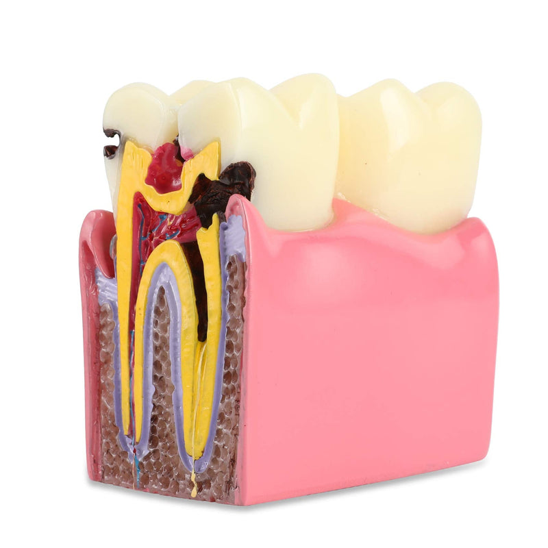 Dental Caries Tooth Model 6 Times Decay Teeth Comparative Study Model, Caries Bilateral Comparison Pathology Teeth Model Teaching Learning Tools for Dentist, Patient Education and Explanation - BeesActive Australia