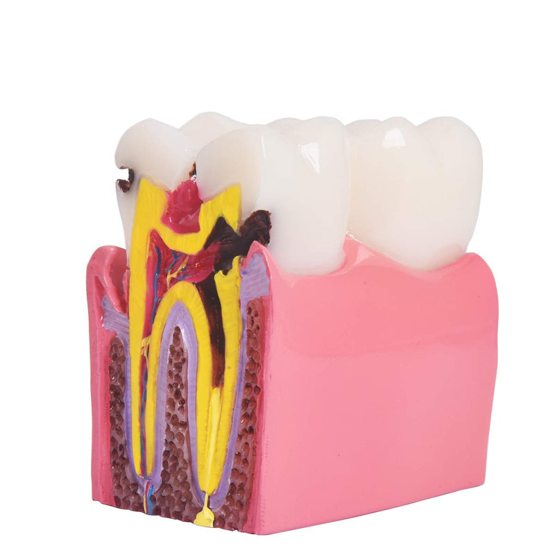 ANNWAH Dental Caries Teeth Model,Dental Anatomy Education Tooth Model,6 Times Caries Teaching Typodont Tool for Dentists, Patients, Teachers and Students - BeesActive Australia