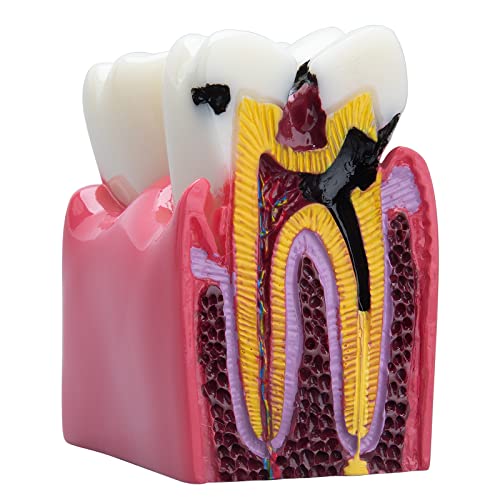 Dental Caries Teeth Model - Anatomy Education Model Caries Bilateral Comparison Study Model 6 Times Cross-Section Demonstration Model Tooth Decay Props for Science Teaching