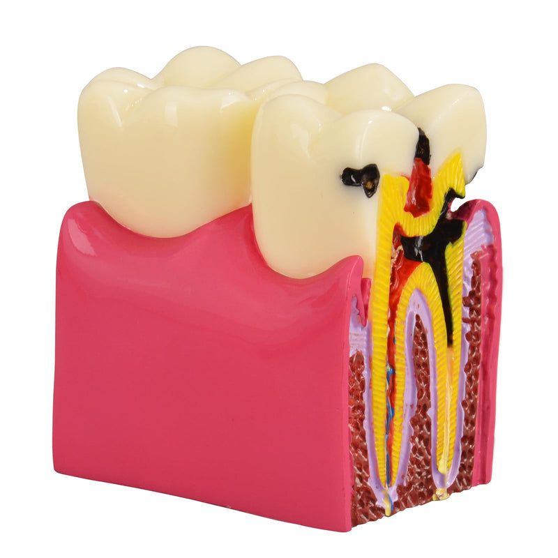 Ultrassist Dental Tooth Decay Model, Dental Caries Demonstration Model, Tooth Anatomy Teaching Model for Dental Education, Patient Explanation and Oral Health Classroom Teaching - BeesActive Australia
