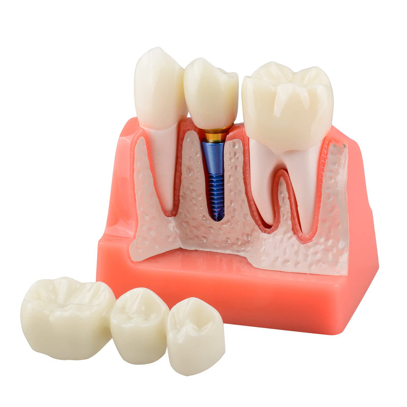 Ultrassist 4 Times Dental Implant Model for Patient Education Pink