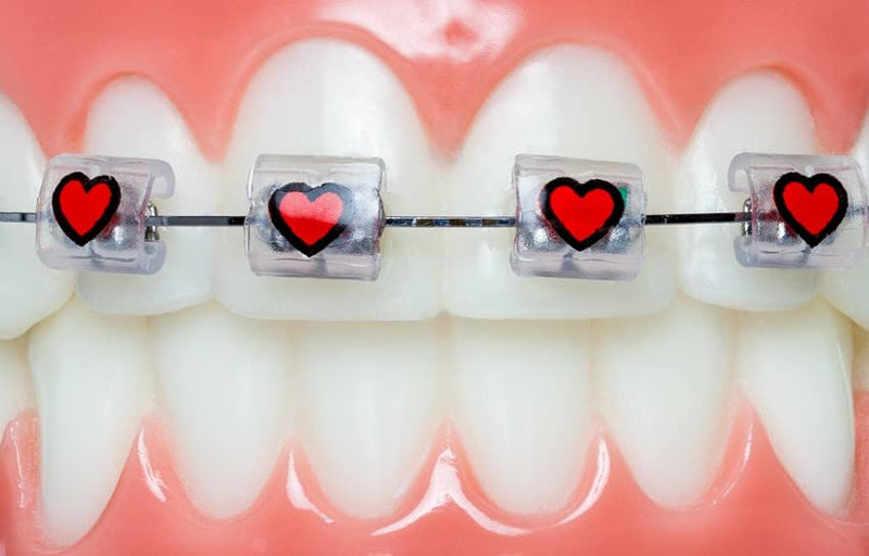 Braces Bumper Cover, Orthodontic Bracket Wax Substitute, Alternative Snap-on Braces Guard Braces Accessories 10 pack (Hearts) Hearts