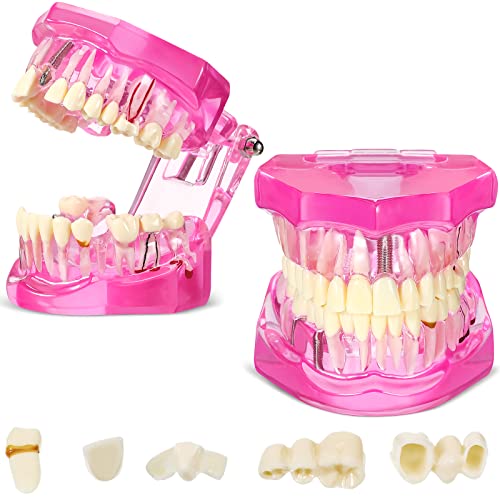 Outus Dental Typodont Model Removable Tooth Implant, Pink, 2 Pcs