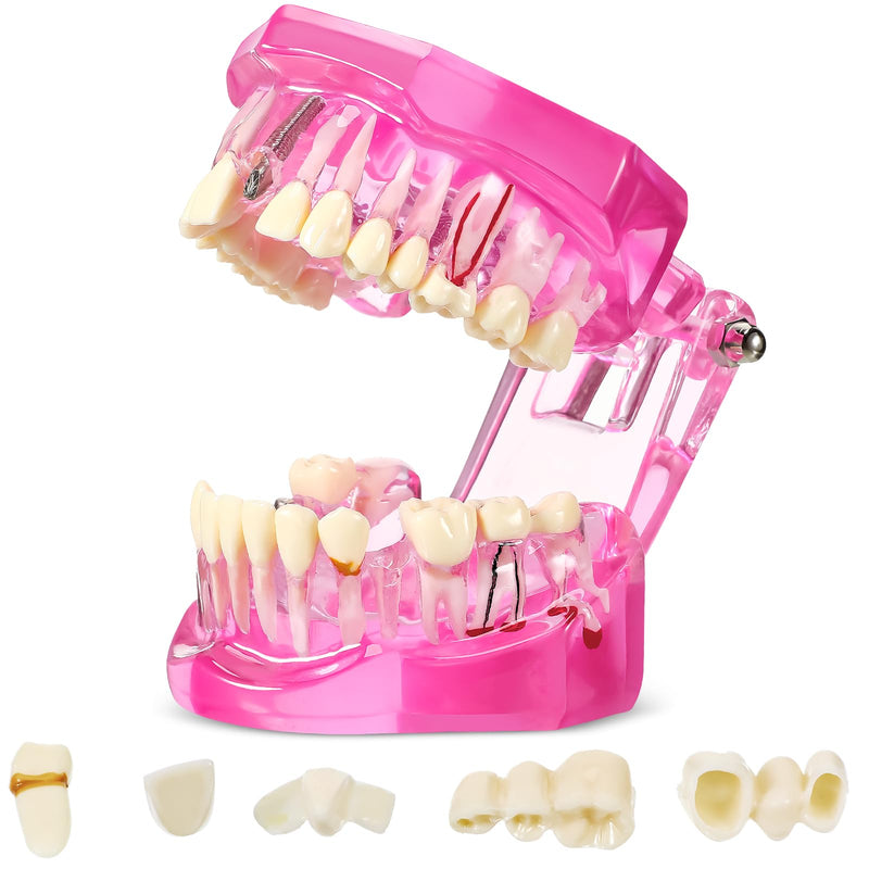 Outus Disease Teeth Model Dental Implant Teeth Model with Removable Tooth Dentist Standard Tooth Pathological Demonstration for Christmas Education Dental Supplies(Pink,1 Pcs) 1 Pink - BeesActive Australia