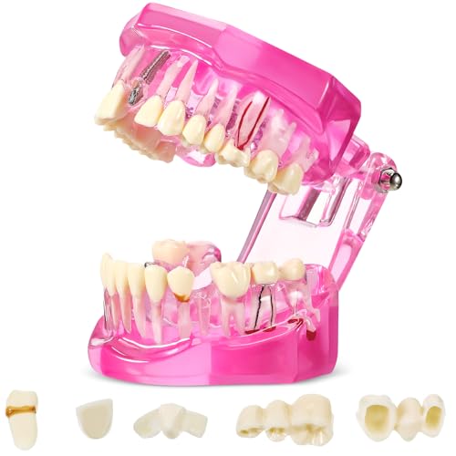 Outus Dental Typodont Model Removable Tooth Implant, Pink, 1 Pcs