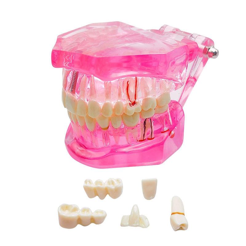 Transparent Disease Teeth Model with Dental Implant Bridge, Dental Teach Crown Bridge Removable Model, Tooth Model for Patient and Dental Student Education. (Red) Red - BeesActive Australia