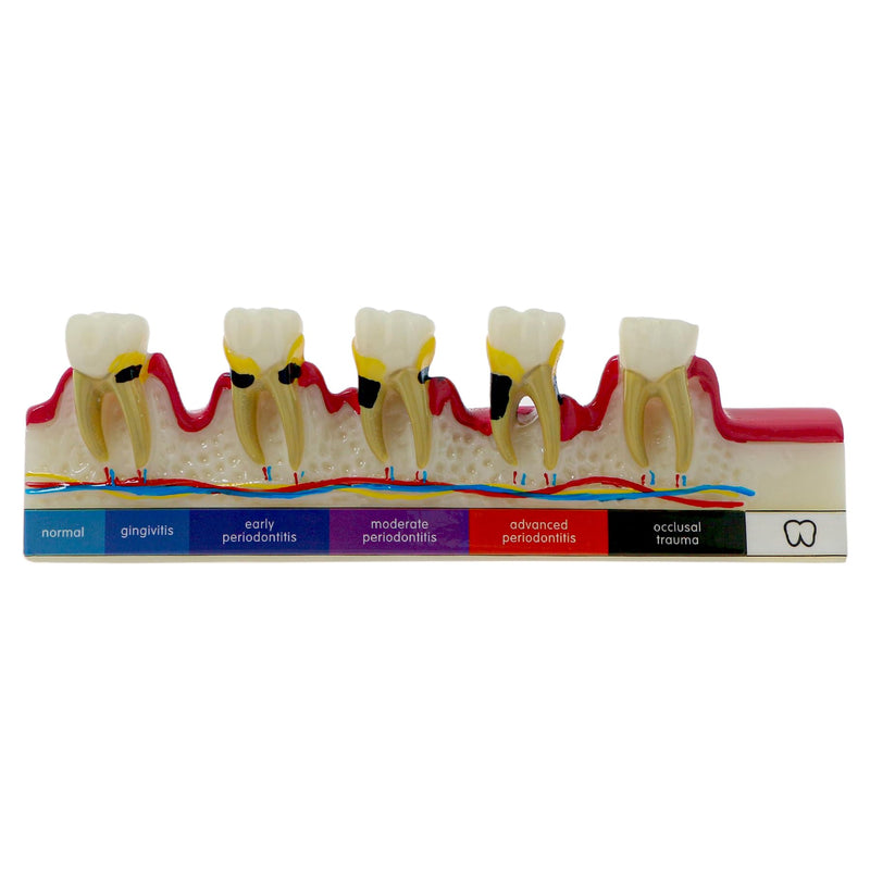 Dental Teeth Model 6-Stage Periodontal Disease Demonstration Model for Dental Education - BeesActive Australia