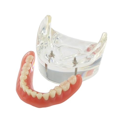 Dental Implant Restoration Model Mandibular Overdenture with 2 Implants