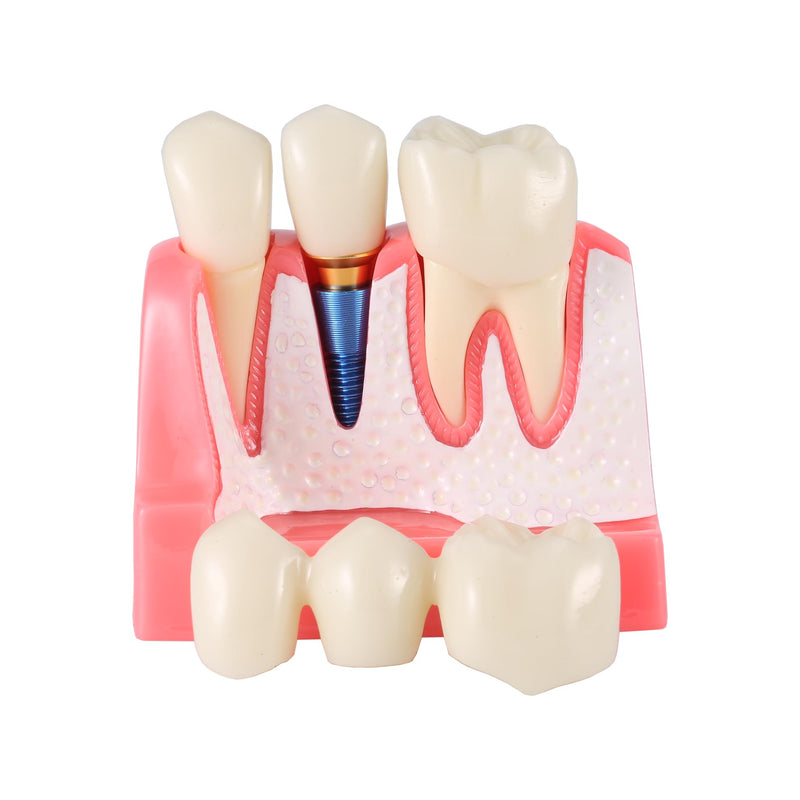 4X Dental Implant Demo Model