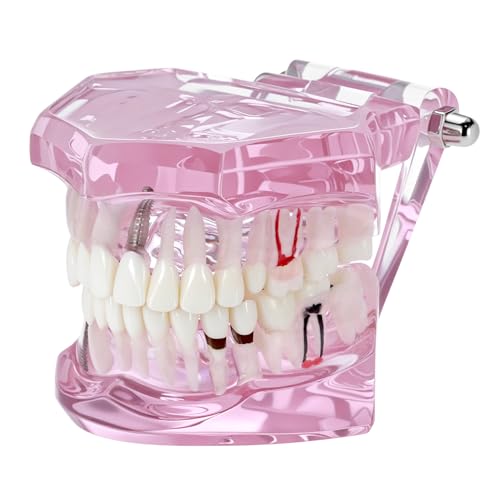 QWORK Dental Implant Teeth Model #2001 Typodont Restoration Pink – Detailed Fixed Prosthetic Study Aid for Dental School Education, Patient Consultation & Training