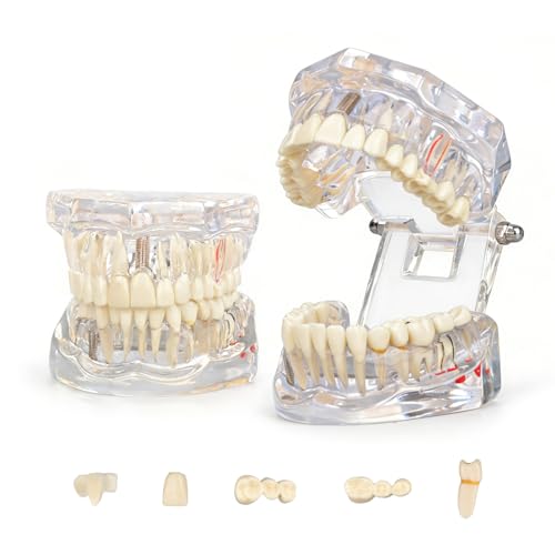 Ultrassist, Transparent Disease Teeth Model 2-Pack with Removable Teeth