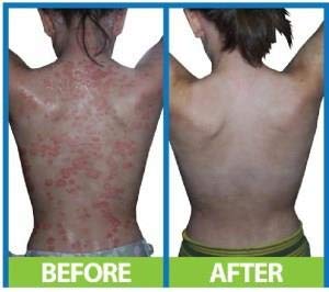 Salcura Natural Skin Therapy, Bioskin Zeoderm Skin Repair Moisturiser, Including Natural Ingredients Relieves Itchiness & Soothes Irritation, Ideal For Severely Dry & Dehydrated Skin 150ml - BeesActive Australia