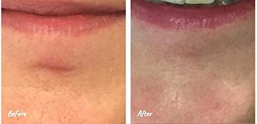 Science of Skin Solution for Scars-Clinically Proven Active Scar Cream. Reduces The Appearance of Old & New Scars. Clinically Proven to Reduce The Appearance of Scarring. Patent Protected Technology Single Unit - BeesActive Australia