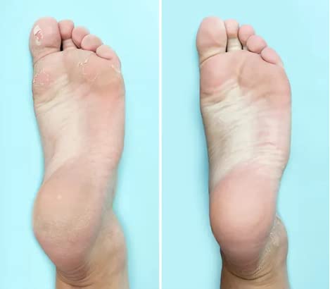 Ever Ready Dual Action Cellular Glass Pumice Stone for Feet, Callus Remover/Foot Scrubber 4 x Pack - BeesActive Australia