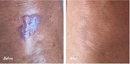 Science of Skin Solution for Scars-Clinically Proven Active Scar Cream. Reduces The Appearance of Old & New Scars. Clinically Proven to Reduce The Appearance of Scarring. Patent Protected Technology Single Unit - BeesActive Australia