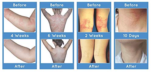 Salcura Natural Skin Therapy, Bioskin Zeoderm Skin Repair Moisturiser, Including Natural Ingredients Relieves Itchiness & Soothes Irritation, Ideal For Severely Dry & Dehydrated Skin 150ml - BeesActive Australia