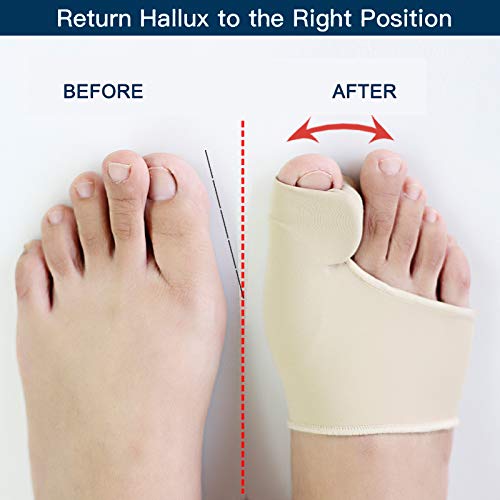 Bunion Corrector Big Toe Straightener Bunion Pain Relief Sleeves, 1 Pair Bunion Splint Support Protectors Sleeve with Built-in Silicone Gel Pad for Hallux Valgus Pain Relief (Upgrade) 1 Pair (Pack of 1) - BeesActive Australia