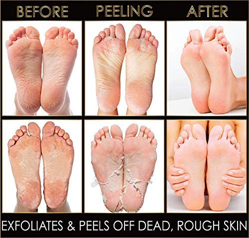 Elite VIP Exfoliating Peeling Foot Mask- 2 Pack- Get rid of cracked heels, calluses, dead & rough skin! At home pedicure for baby soft, silky smooth skin! - BeesActive Australia