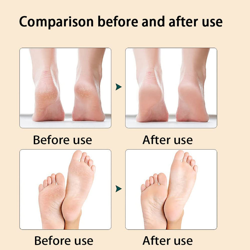 Foot Files for Hard Skin,Foot File Effective Removal Dead Skin Callus Cracked Skin(Pink） - BeesActive Australia
