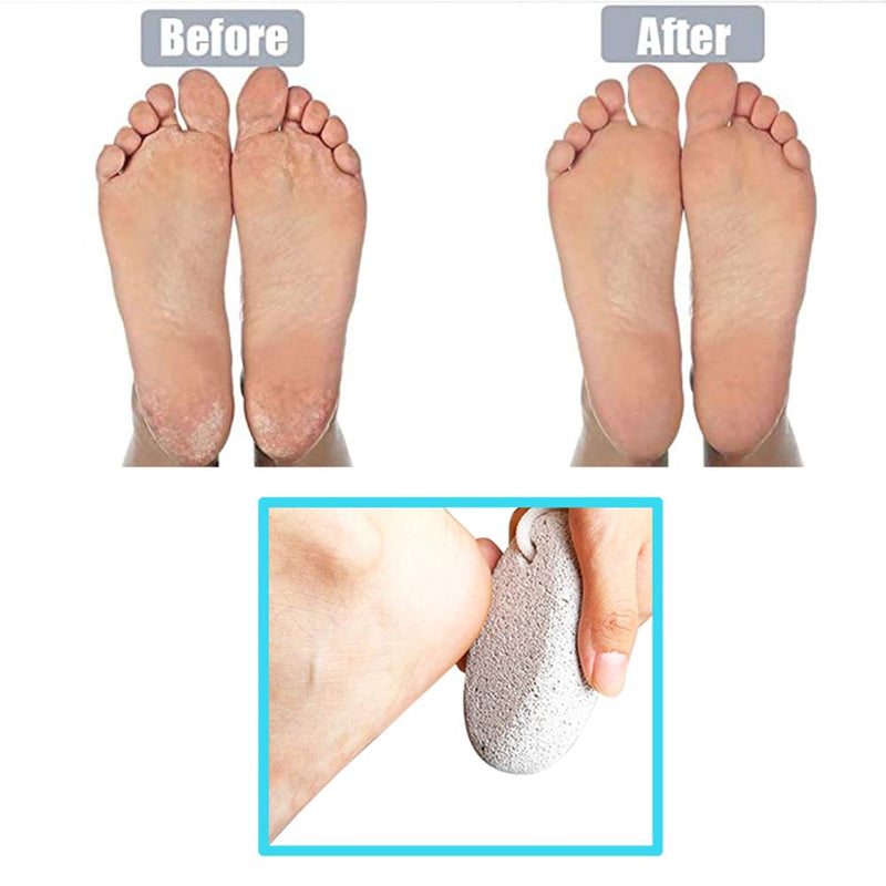 Pumice Stone Feet Hard Skin Remover Foot Scrubber for Dead Skin Removal Foot File and Callus Remover for Skin Exfoliation - BeesActive Australia