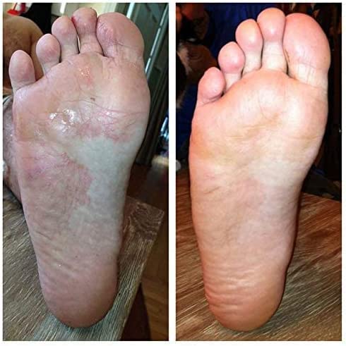 Extra Strong Athletes Foot Treatments Cream | Anti Itch Cream | Anti-Fungal Foot Treatment | Ringworm Foot Care | XL 75 ML - BeesActive Australia