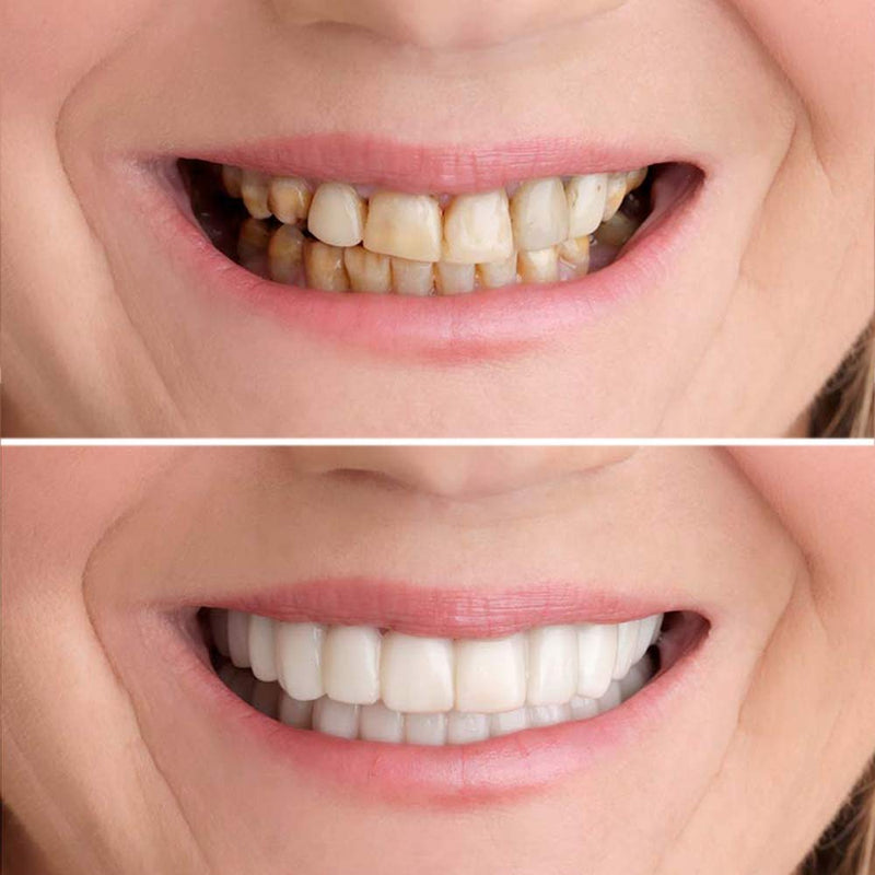 Glamza Get Set Smile Whitening Teeth Snap Cap On Instant Comfortable Flex Perfect Veneers White - BeesActive Australia