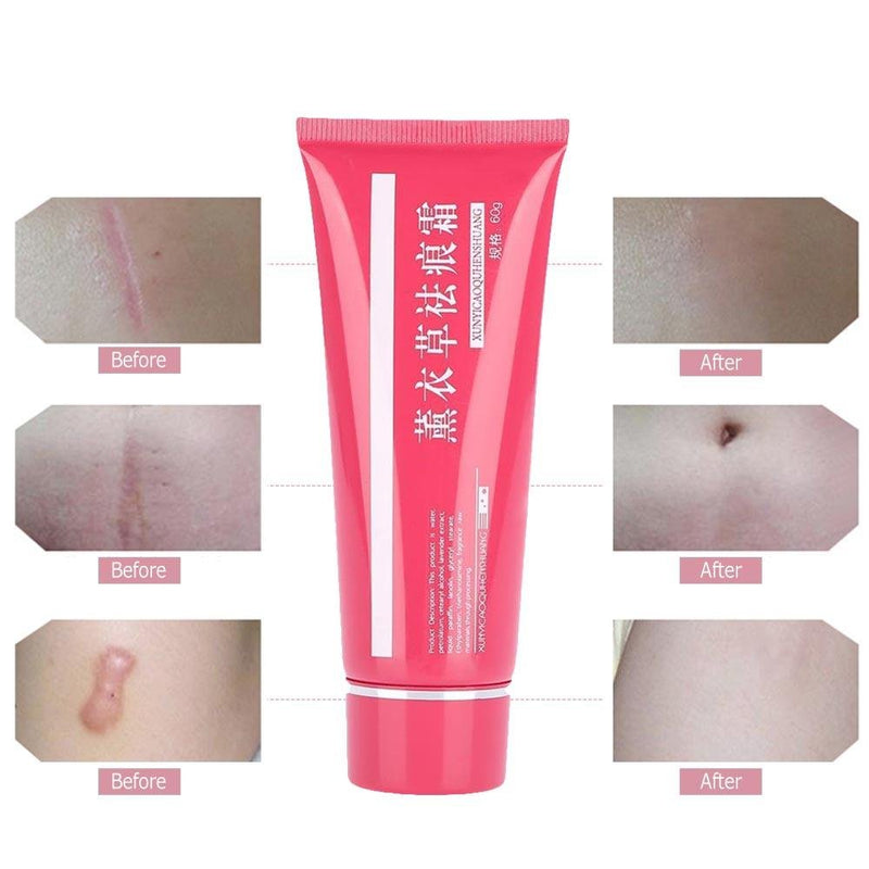 Scar Cream, Reduce Caesarean Scars Cream Skin Care Cream Repair Wounds Blemish - BeesActive Australia