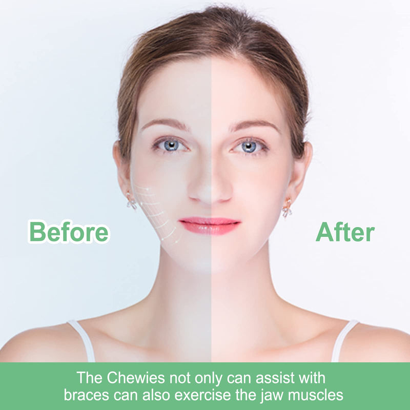 10 Pieces BVN Aligner Chewies for Aligner Chompers Aligner Trays Seater, Orthodontic Dental Chewies, Mint Scent Green 10 Pieces Aligner Chewies - BeesActive Australia