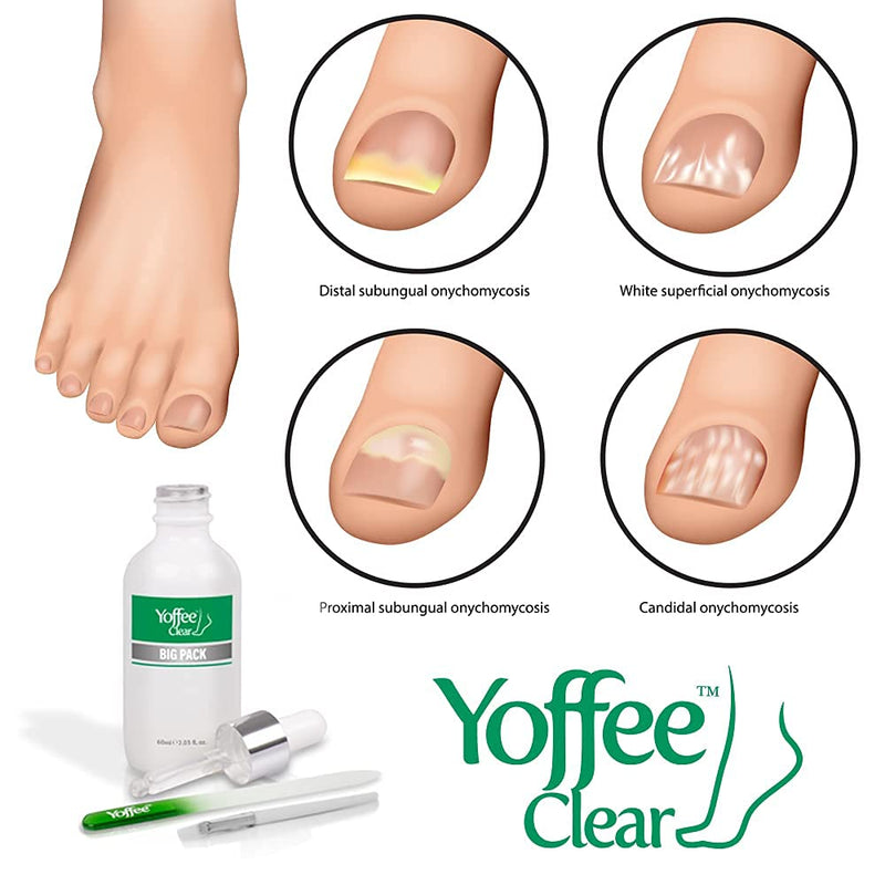 Yoffee Clear Nail Care Kit 2 x 60ml Bottle - Fungal Nail Treatment for Finger and Toe Nail - Antibacterial & Antiseptic - Antifungal with Organic Argan Oil, Tea Tree Oil–Improved Formula/Made in Spain - BeesActive Australia