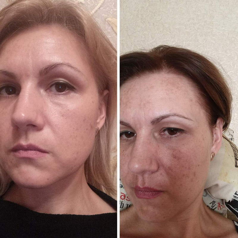 Luxury Swiss Dark Spot Remover for Face Body Serum Hyperpigmentation Treatment Age Sun Melasma Brown Spot Corrector Anti aging Bleaching Skin Lightening Vitamin C + Niacinamide organic Magiclear - BeesActive Australia
