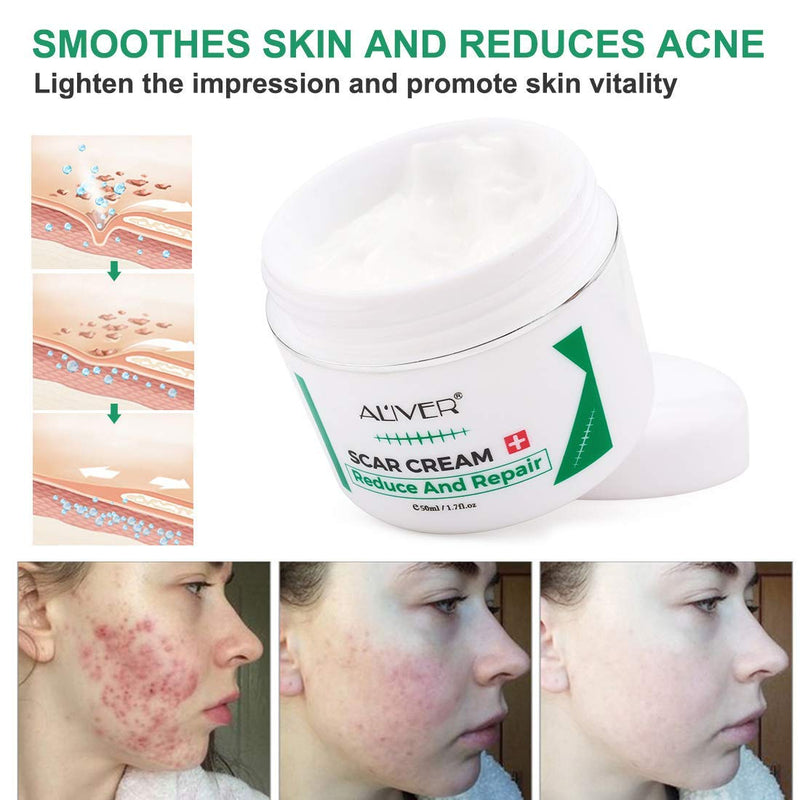 Scar Removal Cream, Scar Cream for Old & New Scars, Stretch Mark Remover, Acne Scar Removal, Body or Face Skin Repair Cream for Cuts,Surgery, Burn.Scar Treatment Cream, Skin Repair Gel for Men & Women - BeesActive Australia