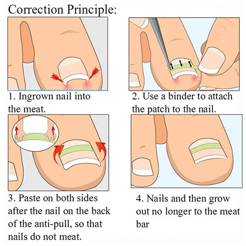 Toenail Correction Tool, 8pcs/set Ingrown Toe Nail Fixer Pedicure Toenail Recover Correction Tool Nail Foot Care Kit (01#12pcs) 01#12pcs - BeesActive Australia