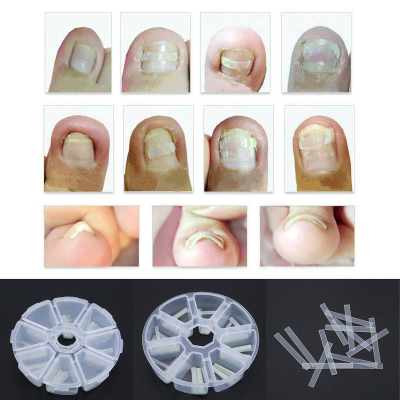 【𝐄𝐚𝐬𝐭𝐞𝐫 𝐏𝐫𝐨𝐦𝐨𝐭𝐢𝐨𝐧 𝐌𝐨𝐧𝐭𝐡】Toe Ingrown Pedicure Straightening Sticker Clip 120pcs/box Ingrown Pedicure Toenail Straightening Clip Toe Nail Sticker Patch Correction Tool - BeesActive Australia